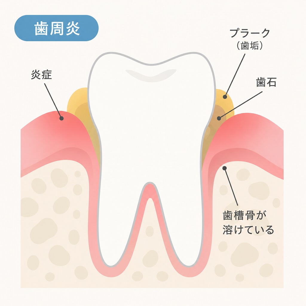 起床時に口の粘りや歯茎から膿が出る