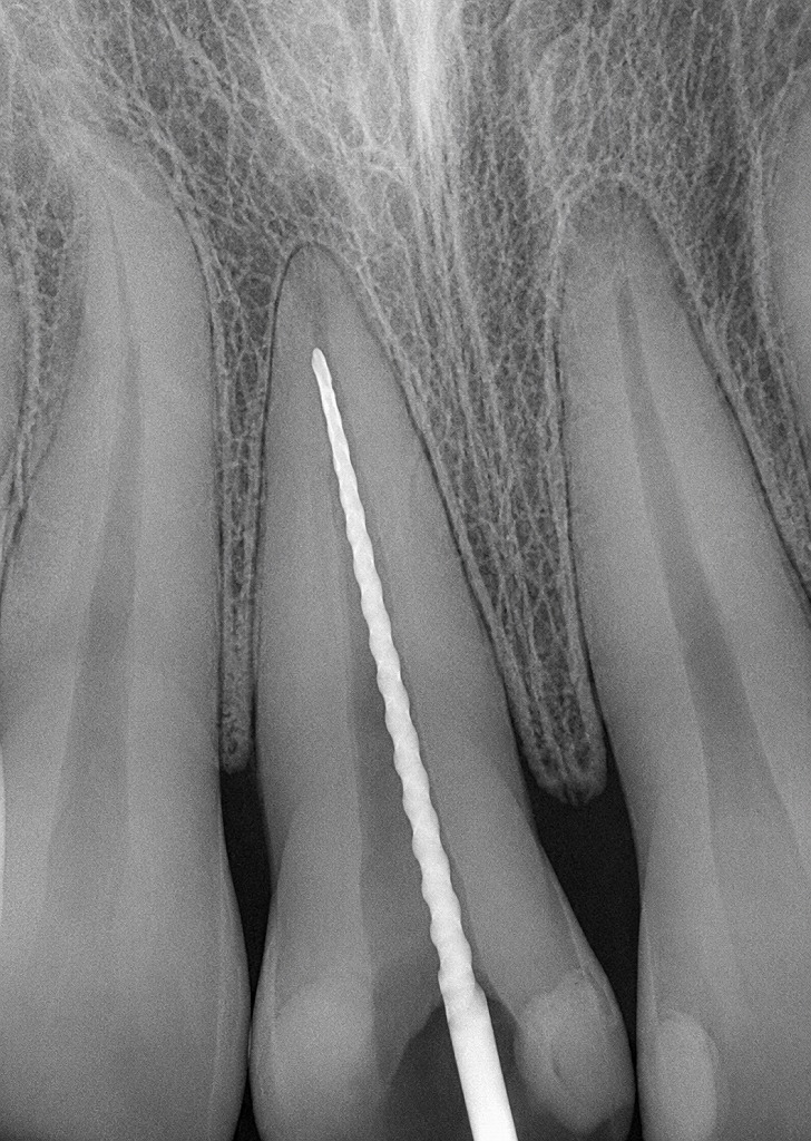 レントゲンで根管長を視覚的に確認