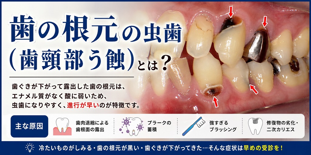 歯の根元の虫歯（歯頸部う蝕）とは