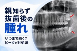 親知らず抜歯後の腫れはいつまで?ピーク・原因・対処法