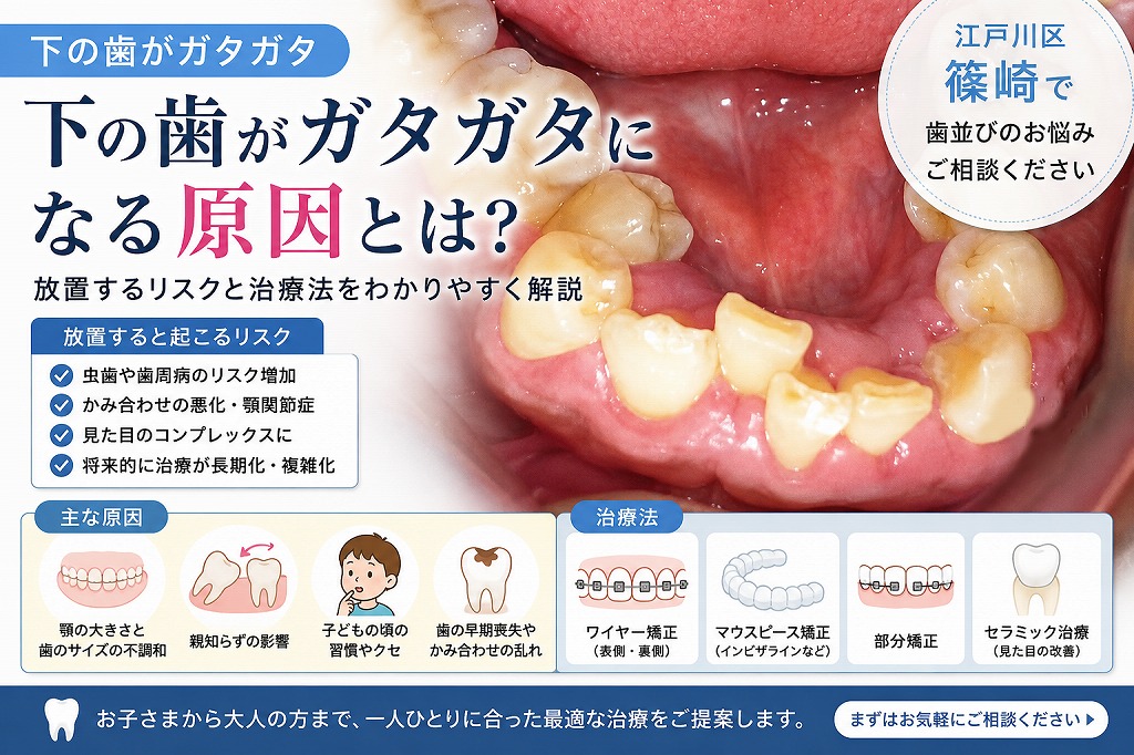 下の歯がガタガタになる原因は？下の前歯の叢生を放置するリスクと矯正治療