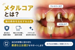 メタルコアとは?ファイバーコアとの違いや歯根破折などのデメリット