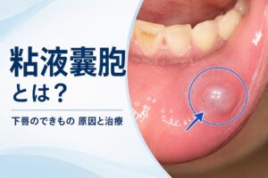 粘液嚢胞とは?下唇の透明なできものの原因・症状・治療法