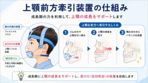 子どもの受け口はいつ治療する？上顎前方牽引装置（フェイシャルマスク）による小児矯正
