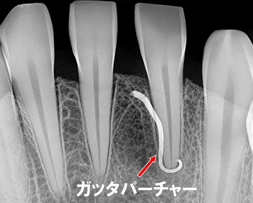 フィステルから挿入したガッタパーチャが左下1番の根尖に到達。
膿の原因となっている感染源を正確に示しています。