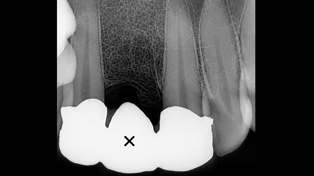 寿命がきた差し歯を抜歯後、ブリッジで補綴した症例（右上顎1番）