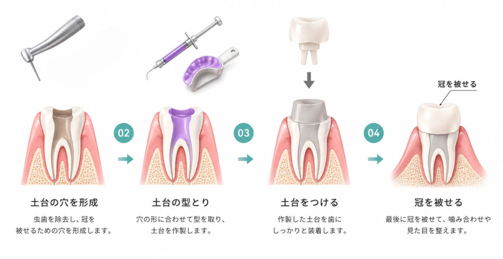 根管治療の流れ 冠を被せるまで。
