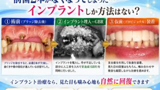 前歯2本がなくなってしまった…インプラントしか方法はないのでしょうか？