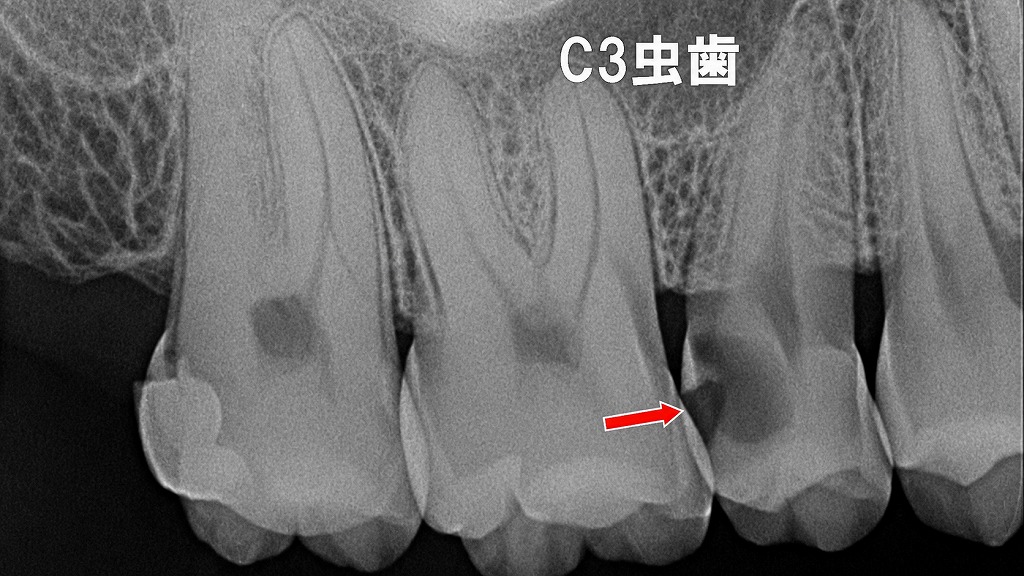 深部う蝕が原因で発症した歯髄炎（C3虫歯）