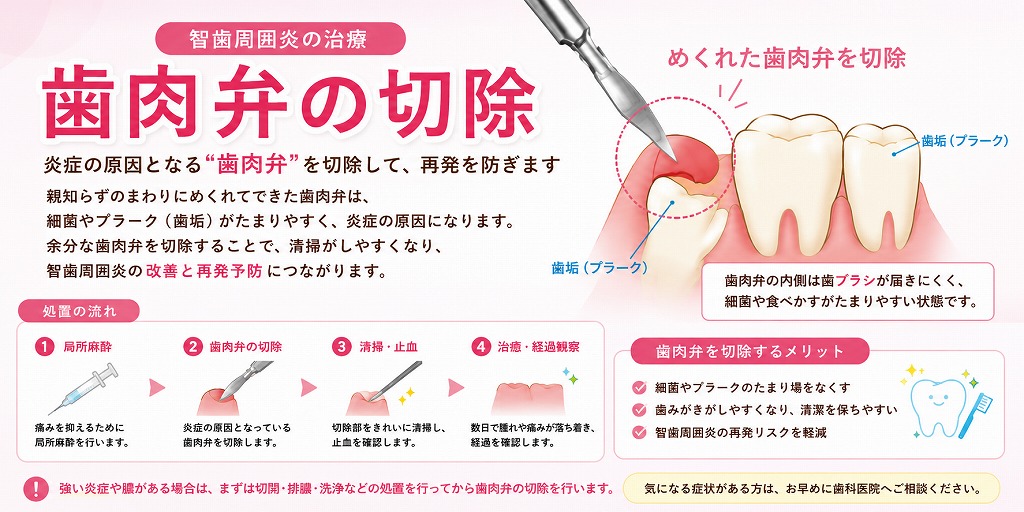 歯肉弁の切除