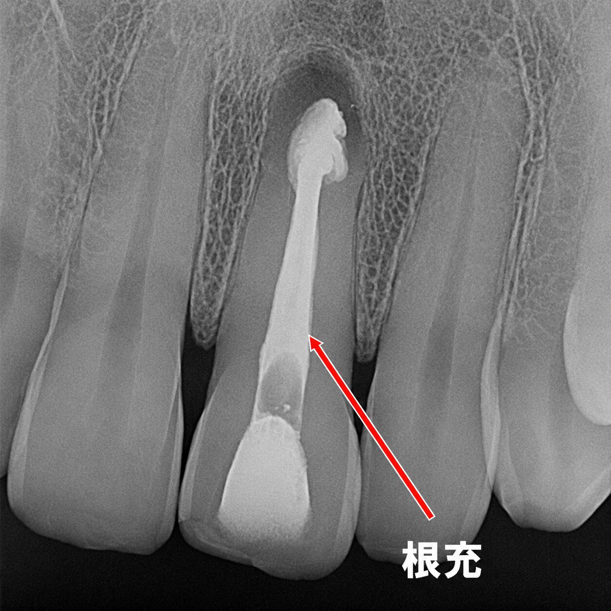 根充完了。吸収歯の根管が均一に封鎖され、感染源を除去した状態。