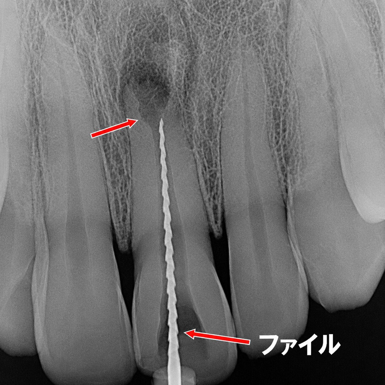 ファイル挿入により根管長を測定。吸収部位の形態を確認しながら作業長を決定。