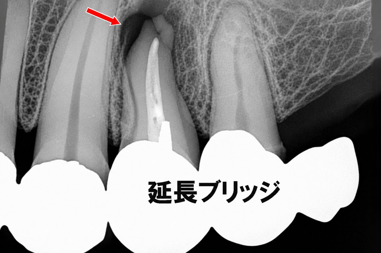 神経を抜いた歯が痛むのはなぜ？延長ブリッジが抱える負担のリスク