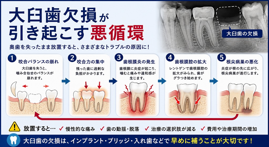 大臼歯欠損が引き起こす悪循環