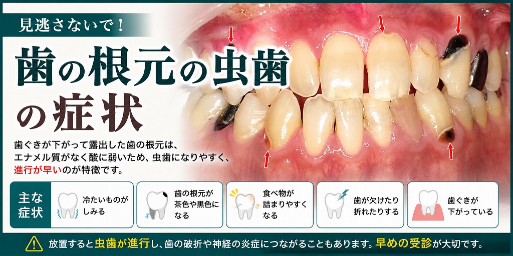 歯の根元の虫歯の症状