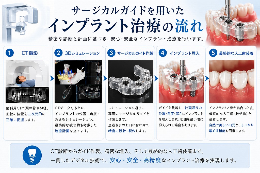 サージカルガイドとは？インプラント手術の精度と安全性を高める方法