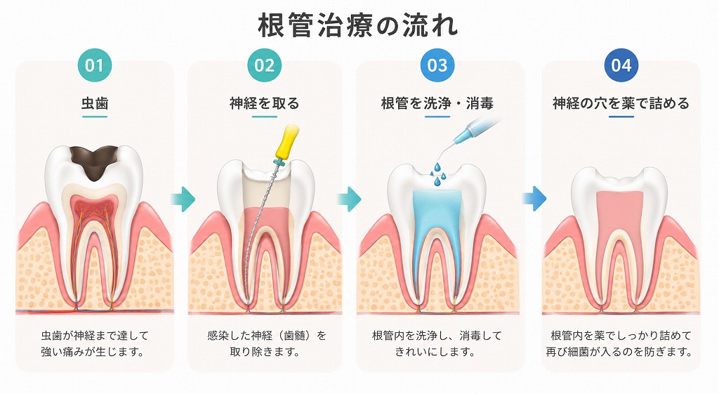 根管治療の流れ 根充まで。