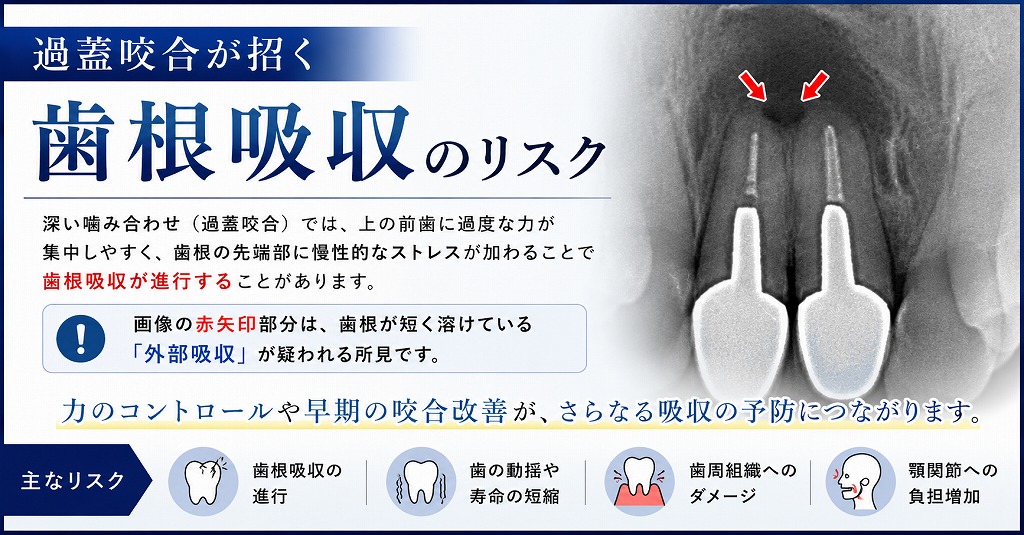 過蓋咬合が招く歯根吸収のリスク