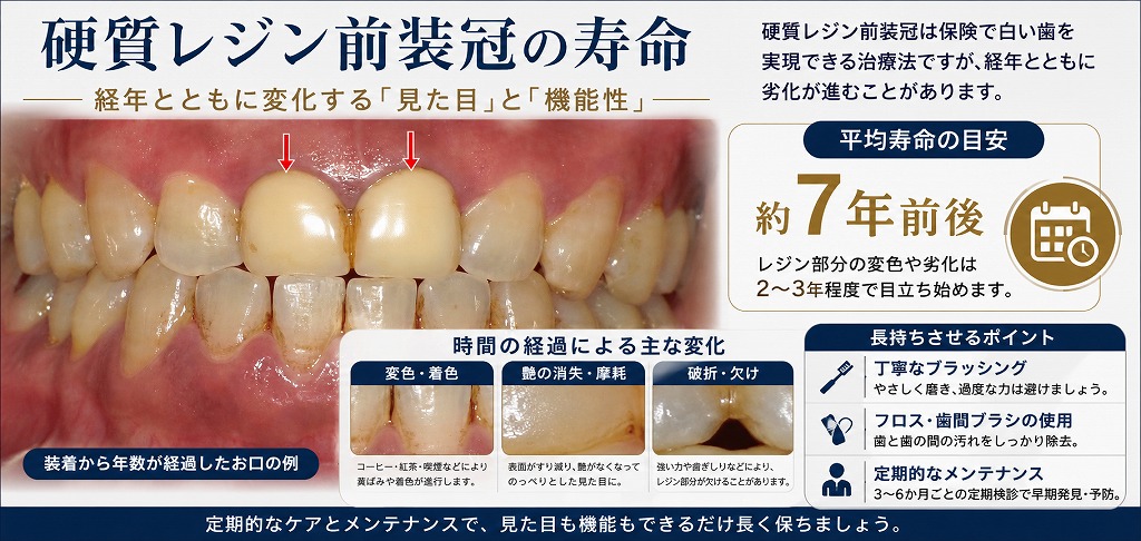 硬質レジン前装冠の寿命