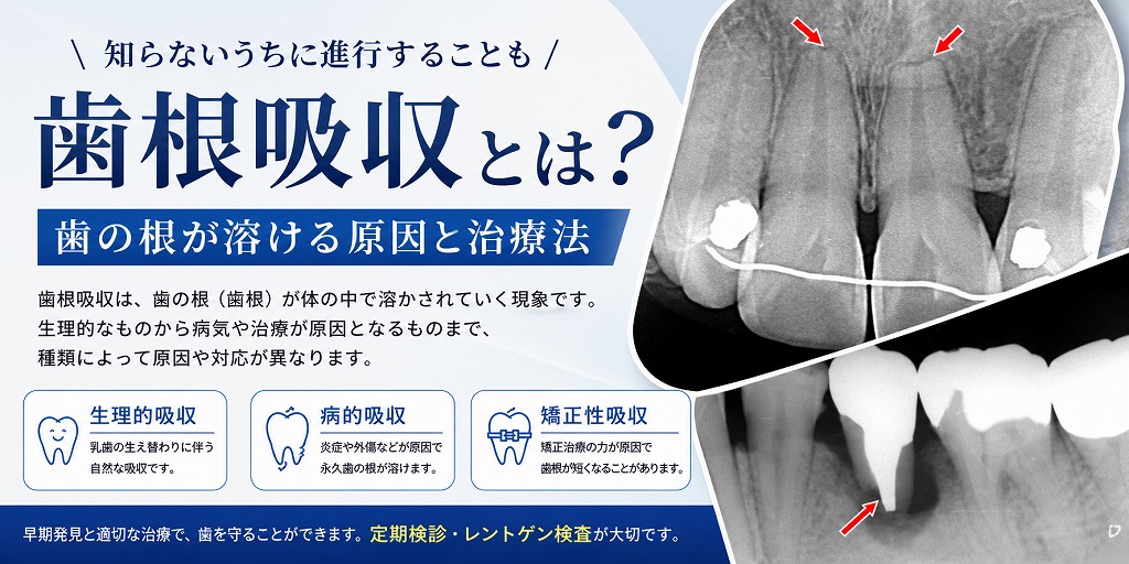 歯根吸収とは?