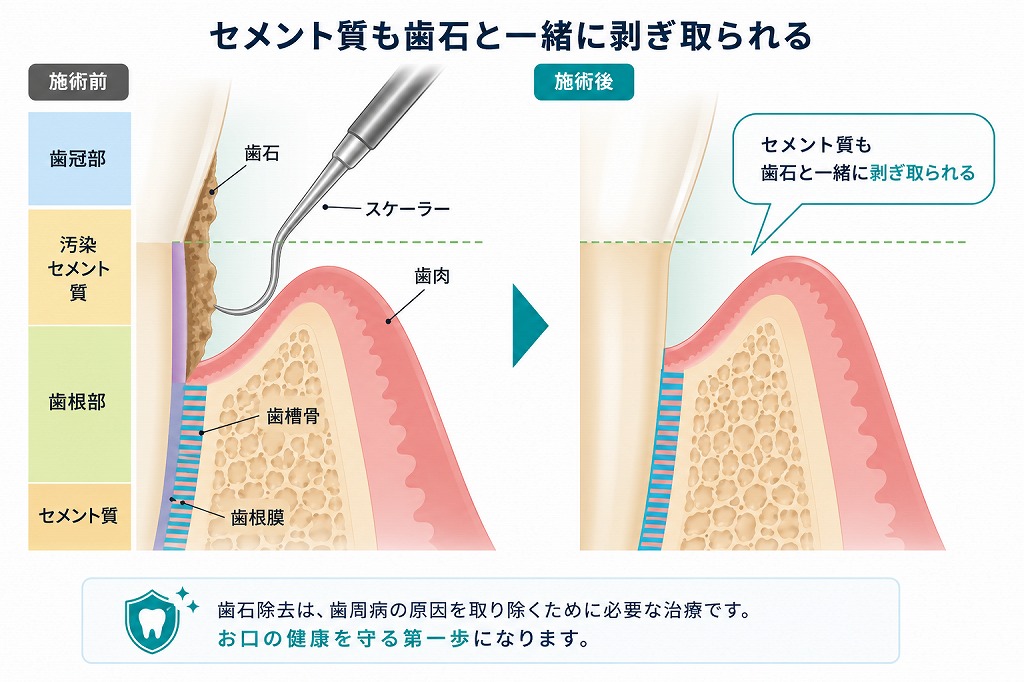ルートプレーニング