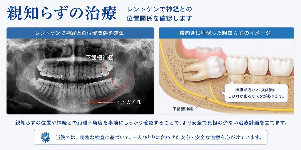 親知らずの治療
