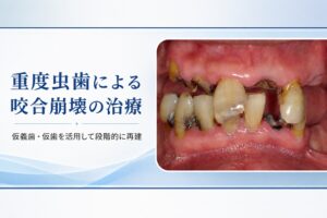 重度虫歯で噛み合わせが崩壊した症例｜仮義歯・仮歯を活用した保険治療
