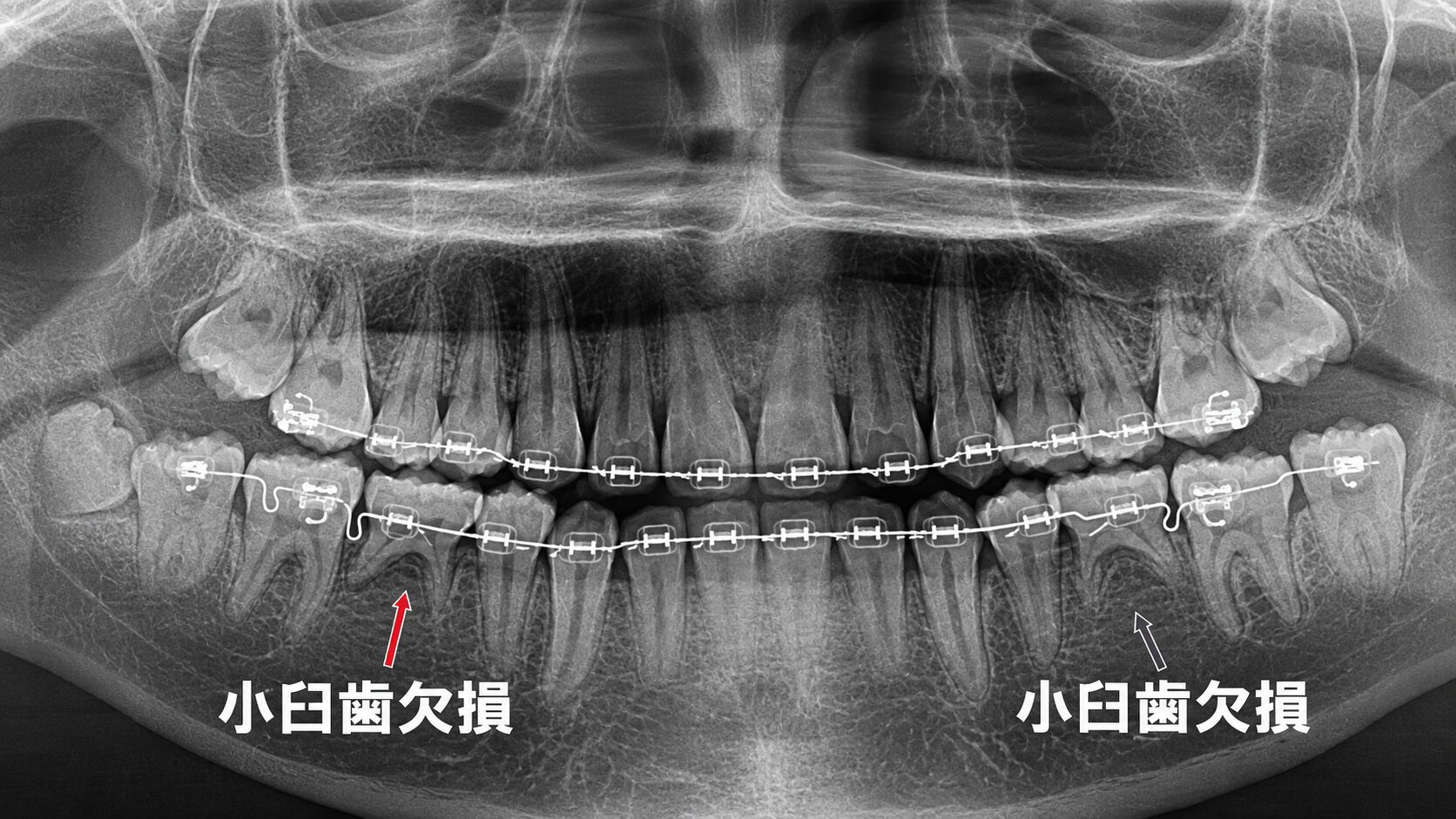 先天欠損した第二小臼歯を考慮して行う矯正治療のレントゲン
