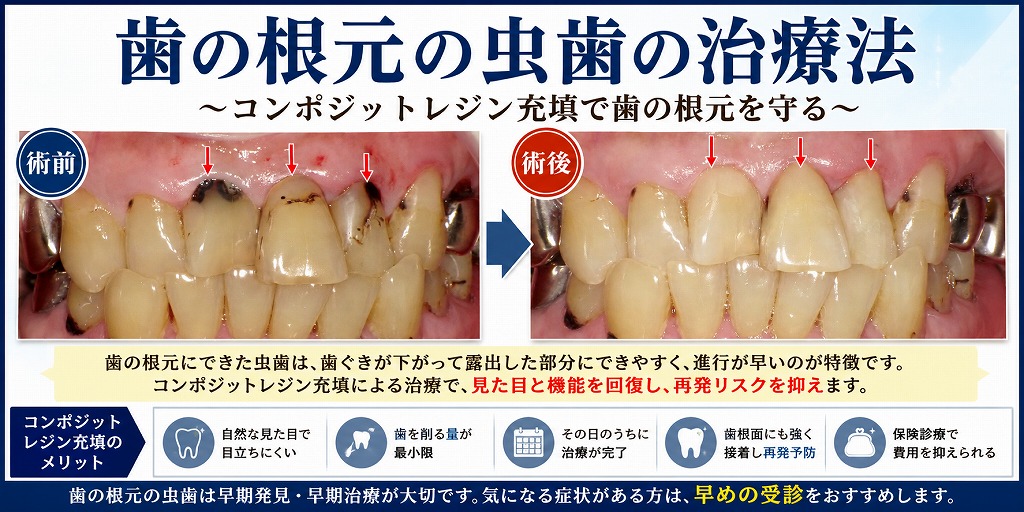 歯の根元の虫歯の治療法