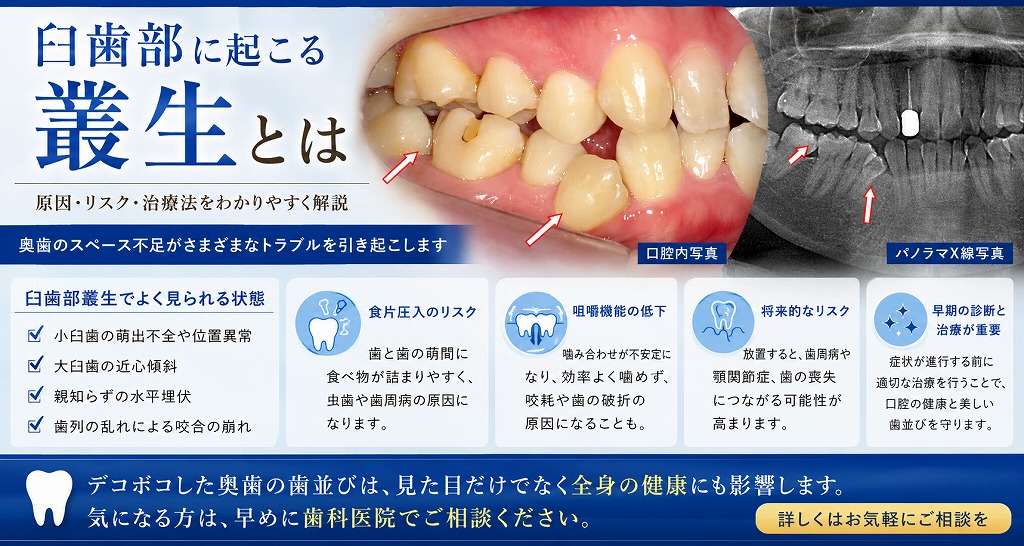 臼歯部に起こる叢生