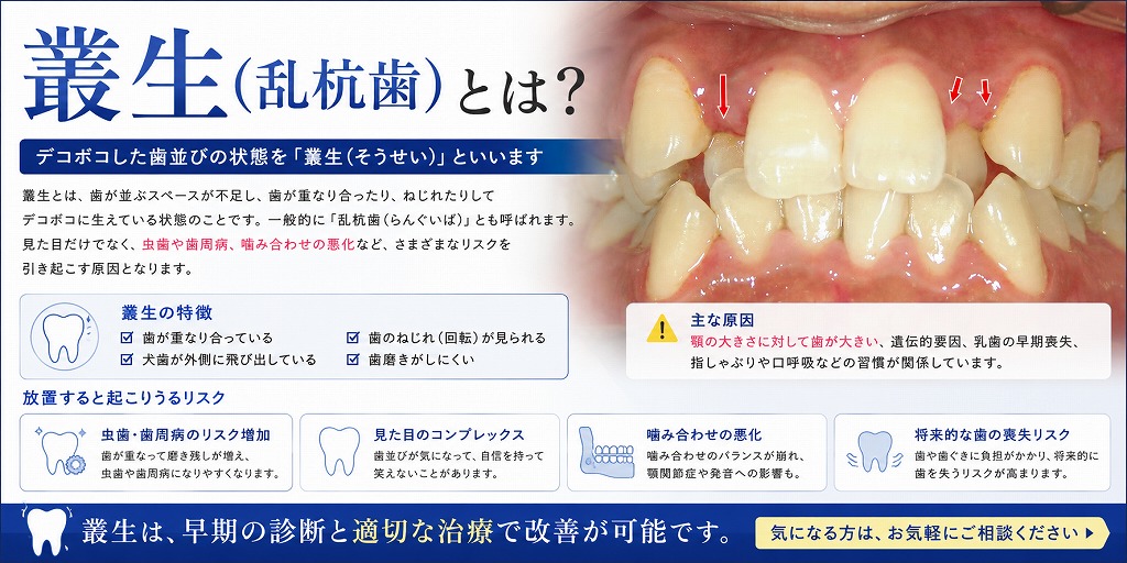 叢生(乱杭歯)とは