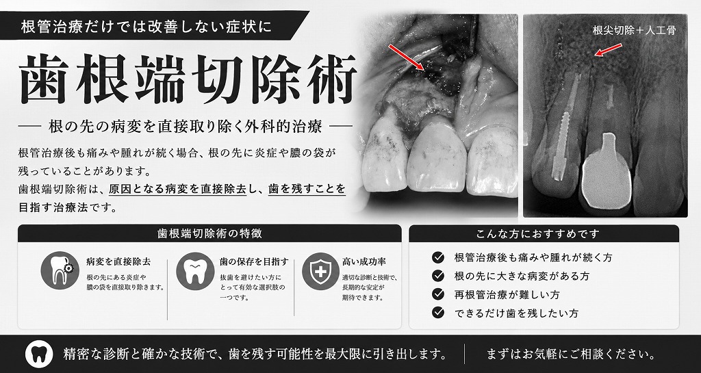 歯根端切除術