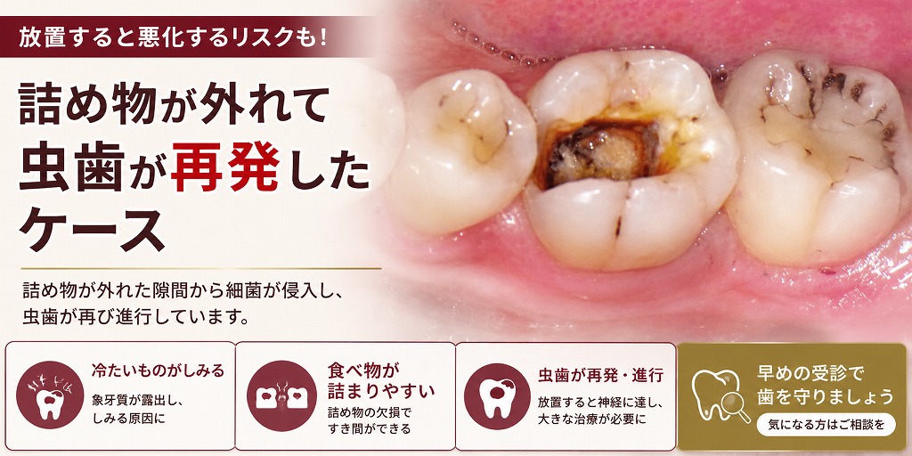 詰め物が外れて虫歯が再発したケース