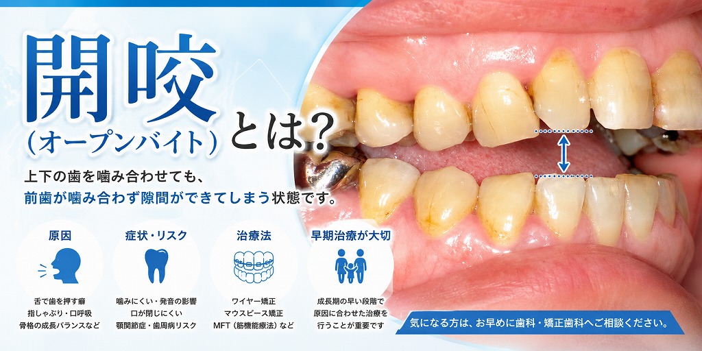 開咬（オープンバイト）とは