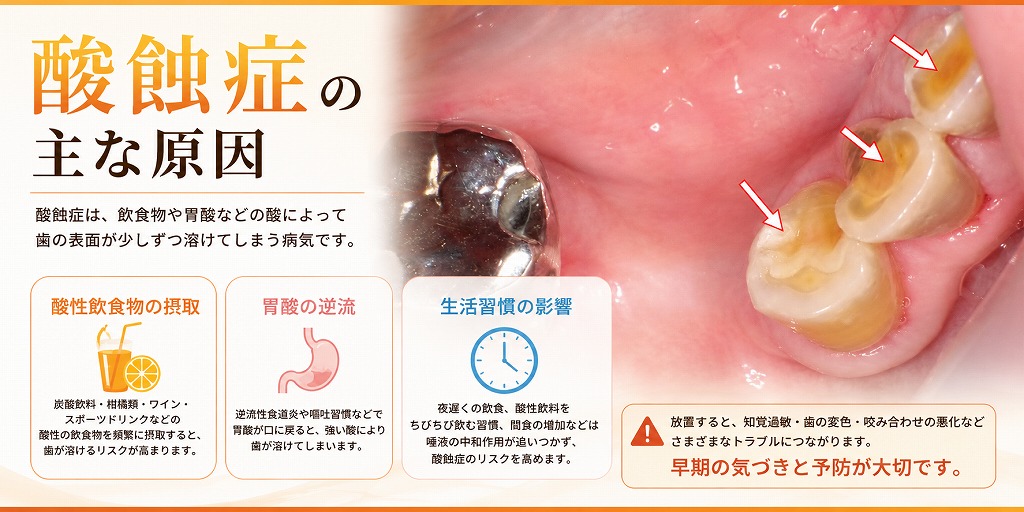 酸蝕症の主な原因