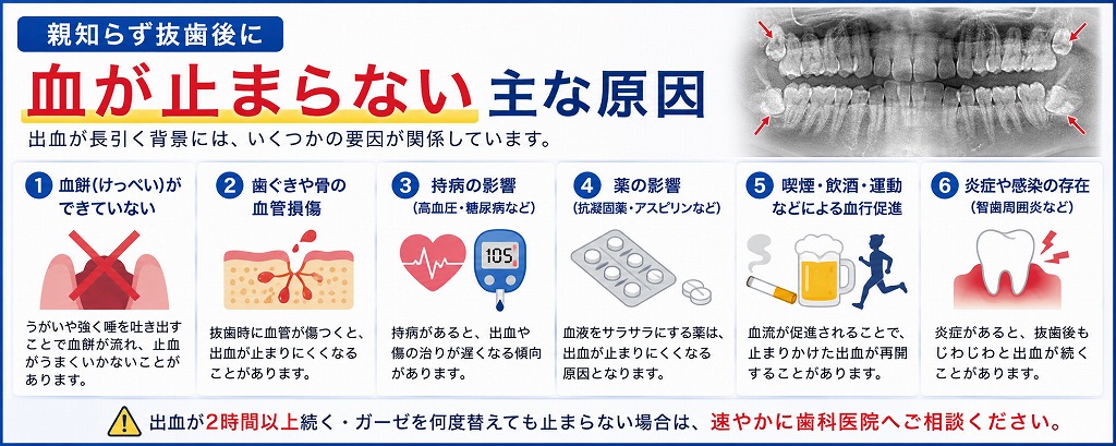 親知らず抜歯後に血が止まらない主な原因