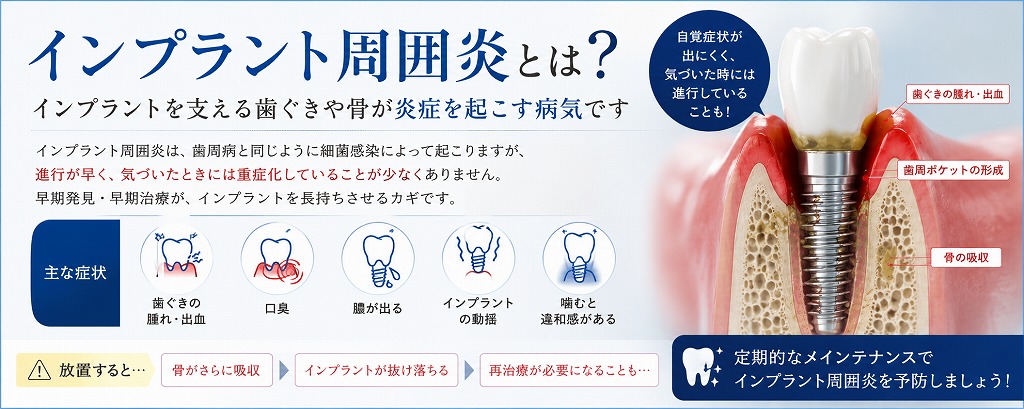 インプラント周囲炎とは？