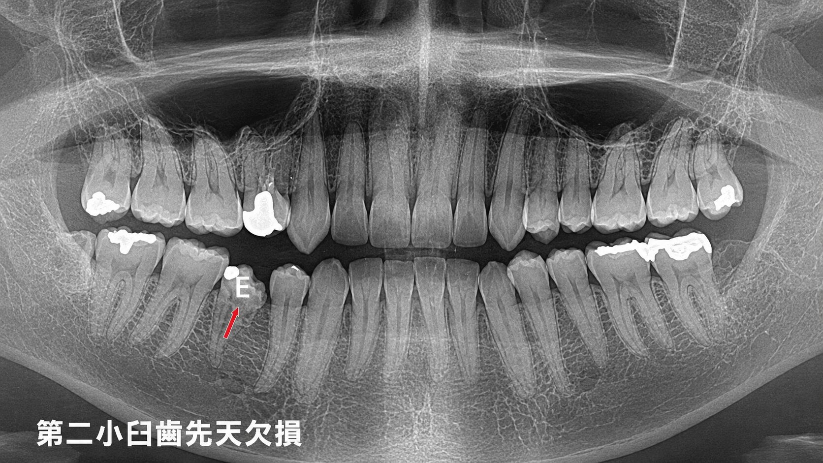 小臼歯の先天欠損が引き起こす前歯スペースと咬合異常の可能性がある症例