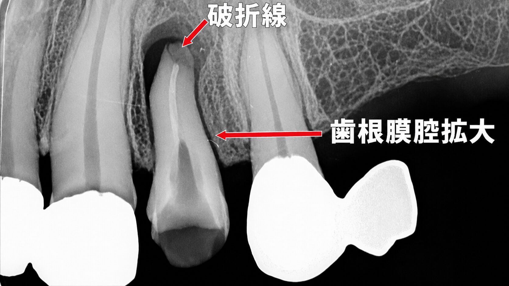 延長ブリッジの負担で根に亀裂が進行　根管治療を試みるも抜歯に至った症例