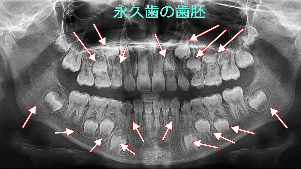 永久歯の歯胚