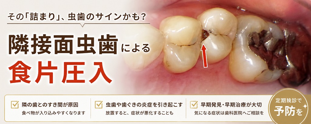隣接面虫歯による食片圧入