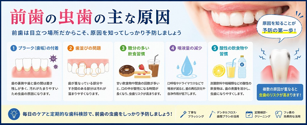 前歯の虫歯の主な原因