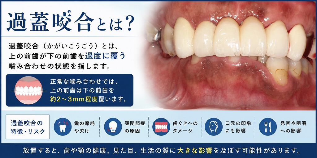 過蓋咬合とは
