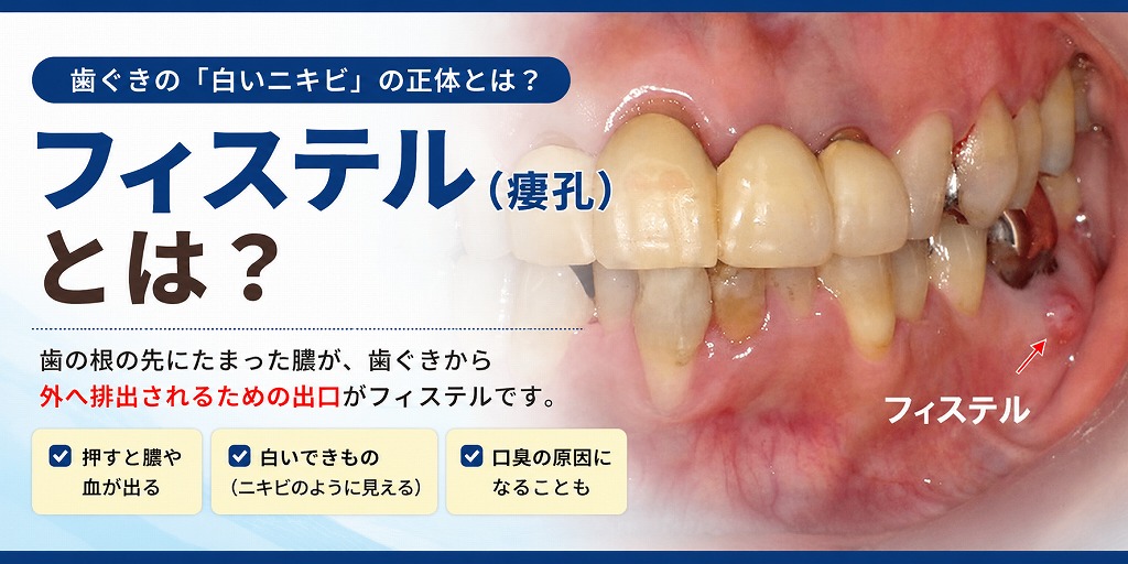 フィステル（瘻孔）とは？