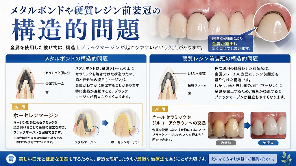メタルボンドや硬質レジン前装冠の構造的問題