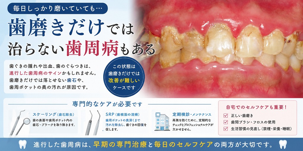 歯磨きだけでは治らない歯周病もある