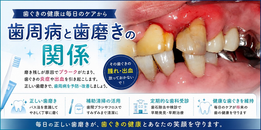 歯周病と歯磨きの関係