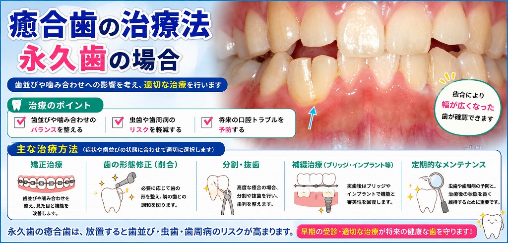 癒合歯の治療法　永久歯の場合