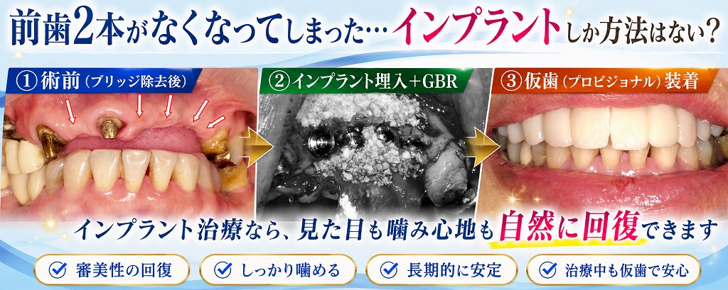 前歯2本がなくなってしまった…インプラントしか方法はない？