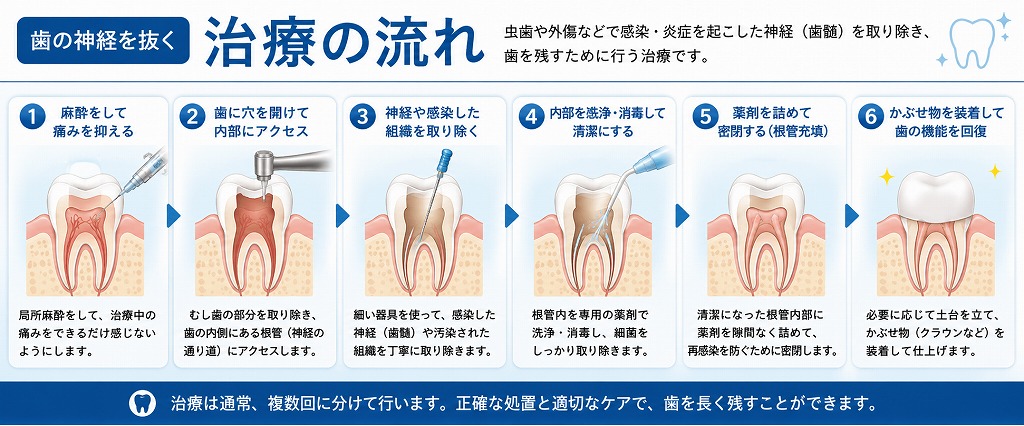 歯の神経を抜く治療の流れ